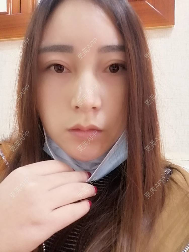 更美 - 更美用户35W00VbmuW的玻尿酸苹果肌经验 | 玻尿酸苹果肌 | 成都