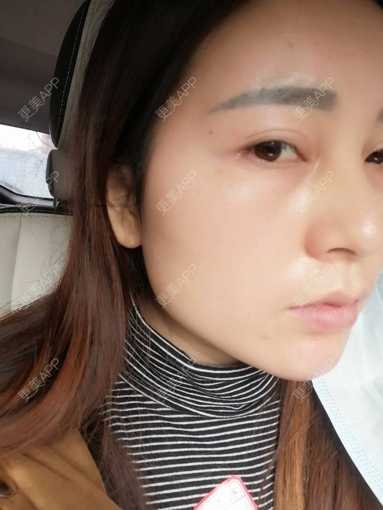 更美 - 更美用户35W00VbmuW的玻尿酸苹果肌经验 | 玻尿酸苹果肌 | 成都
