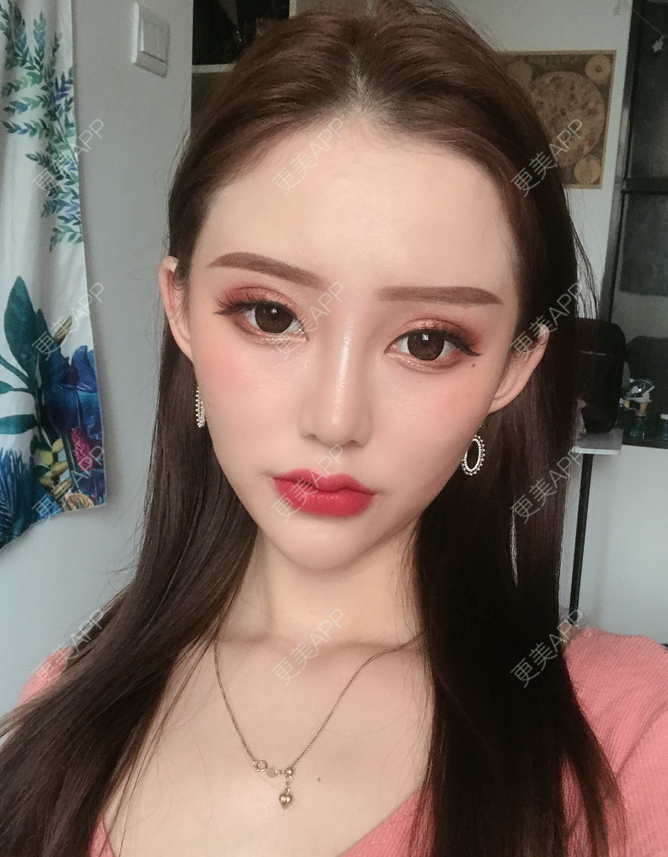更美 - 更美用户fHTaaDv4A5的玻尿酸唇部经验 | 玻尿酸唇部 | 视频日记
