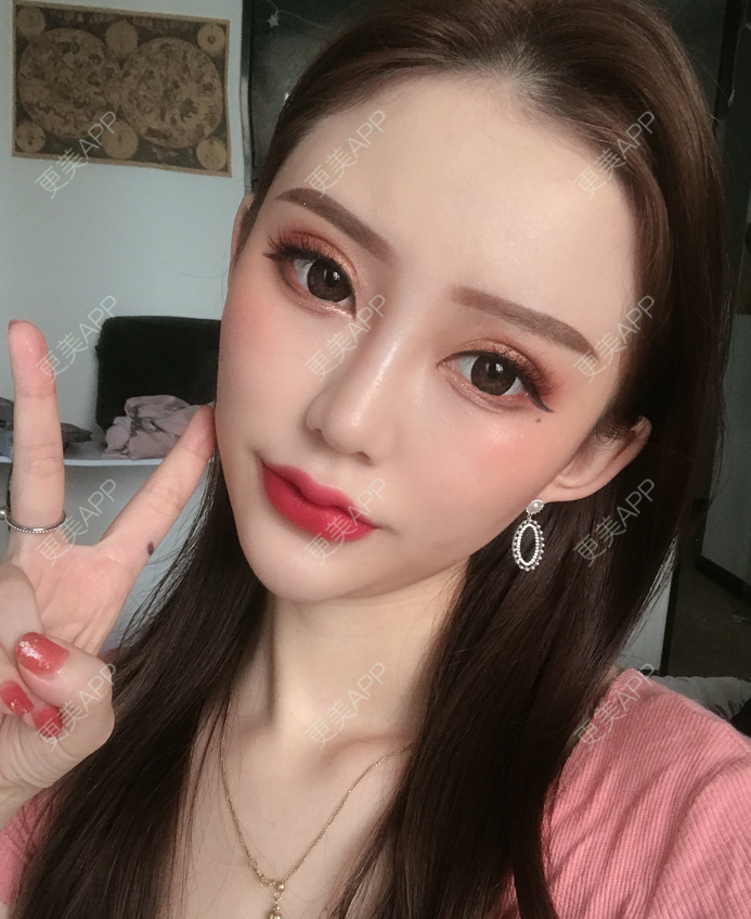 更美 - 更美用户fHTaaDv4A5的玻尿酸唇部经验 | 玻尿酸唇部 | 视频日记
