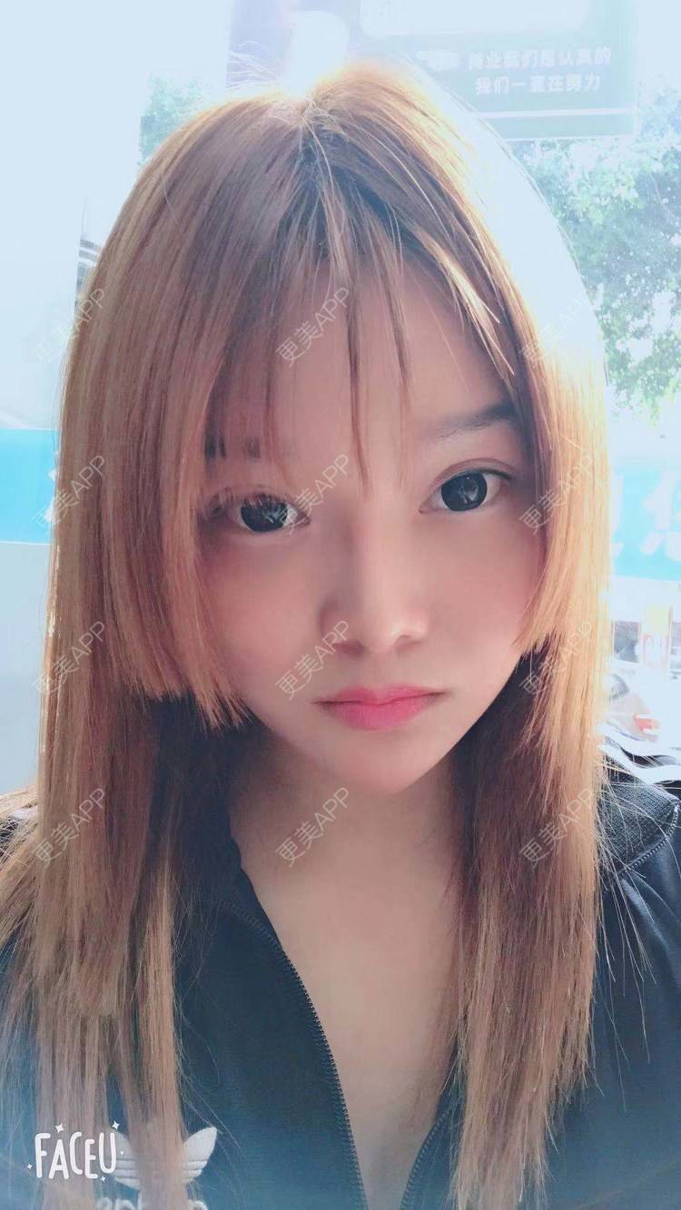 更美 - 小小小迷妹的吸脂瘦脸经验 | 吸脂瘦脸 | 双下巴吸脂 | 深圳