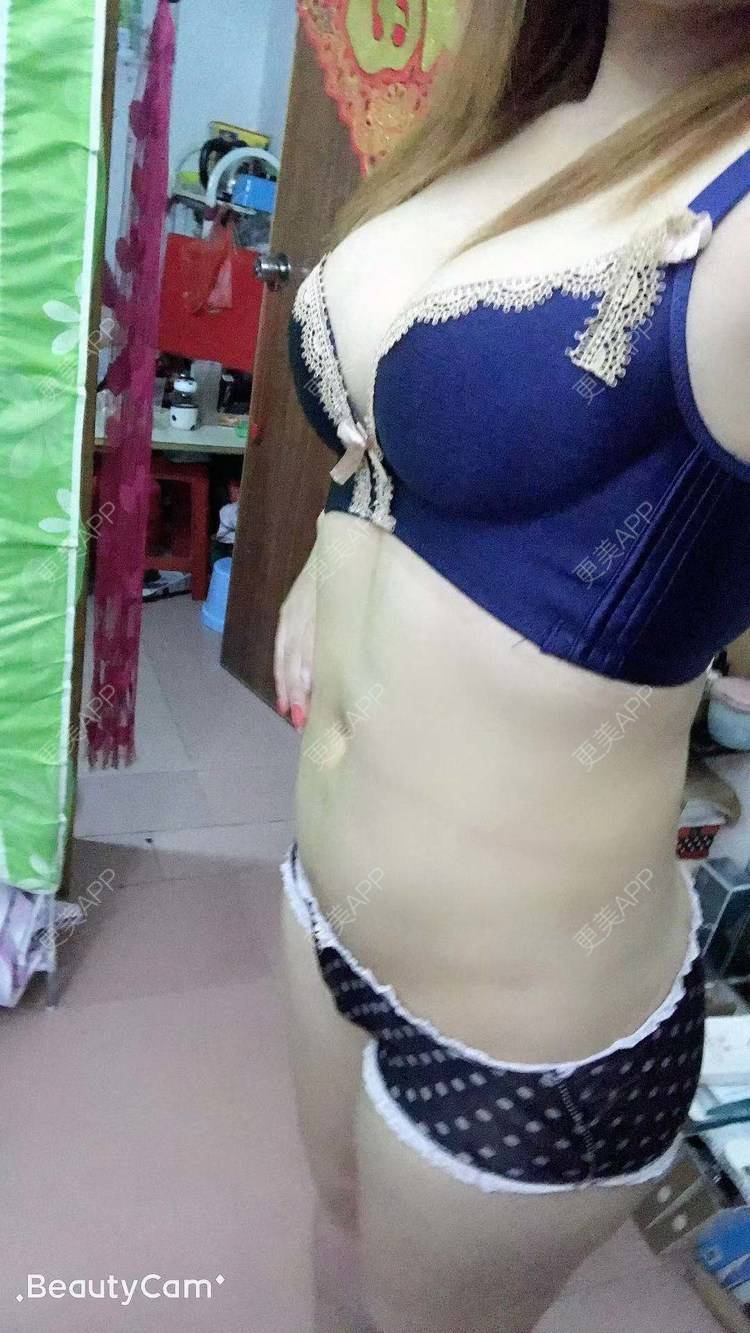 更美 - 小小小迷妹的吸脂瘦脸经验 | 吸脂瘦脸 | 双下巴吸脂 | 深圳