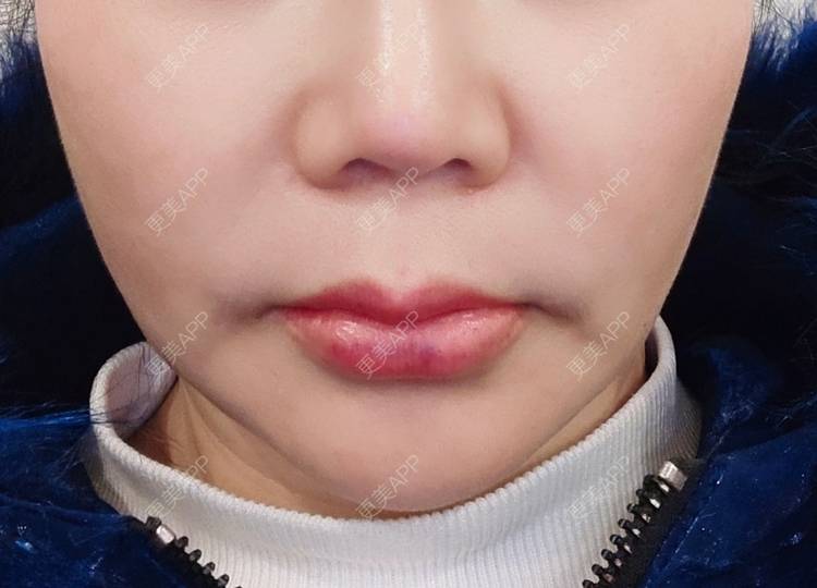 更美 - 定格青春的玻尿酸唇部经验 | 玻尿酸唇部 | 上海