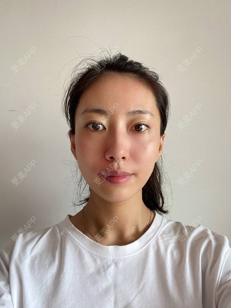 更美 - 富力小姐姐的射频溶脂瘦脸经验 | 北京 | 热玛吉 | 射频溶脂瘦脸