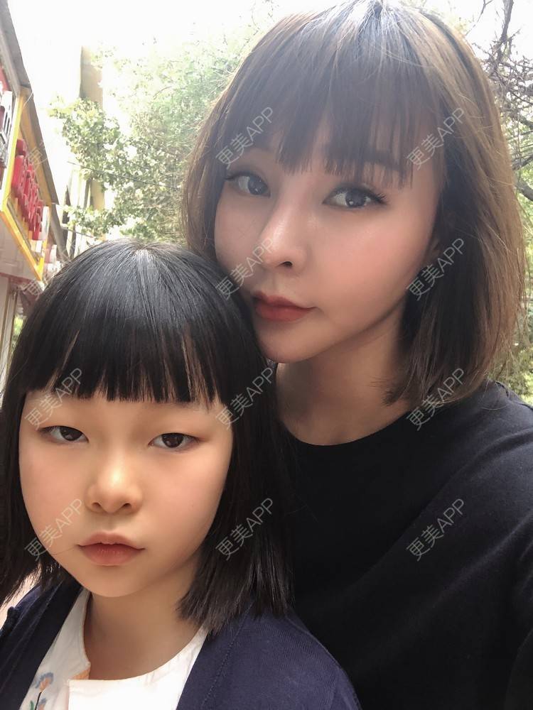 更美 - 更美用户w7xzDQyhGZ的鼻部多项经验 | 肋软骨隆鼻 | 鼻部硅胶假体取出 | 鼻部多项 | 鼻形态修复