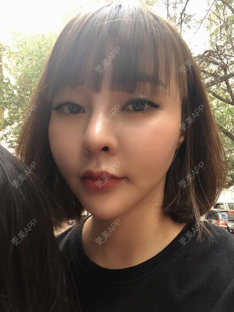 更美 - 更美用户w7xzDQyhGZ的鼻部多项经验 | 肋软骨隆鼻 | 鼻部硅胶假体取出 | 鼻部多项 | 鼻形态修复