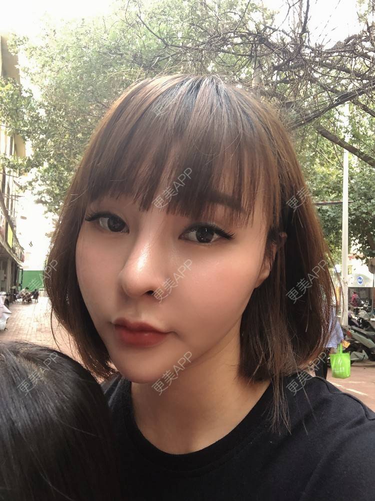 更美 - 更美用户w7xzDQyhGZ的鼻部多项经验 | 肋软骨隆鼻 | 鼻部硅胶假体取出 | 鼻部多项 | 鼻形态修复