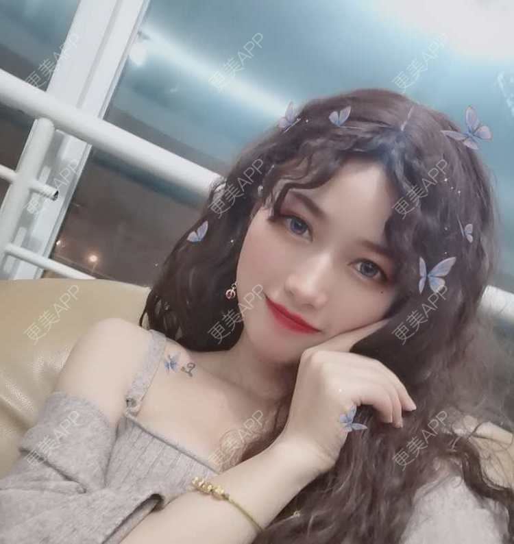 更美 - 更美用户7KURV99YHb的内切去眼袋经验 | 北京 | 眶隔脂肪释放 | 射频去眼袋 | 内切去眼袋 | 激光去眼袋