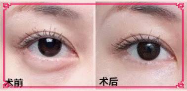 更美 - kris味苮女廖的内切去眼袋经验 | 北京 | 内切去眼袋