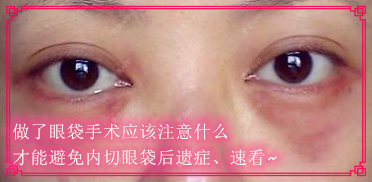 更美 - kris味苮女廖的内切去眼袋经验 | 北京 | 内切去眼袋