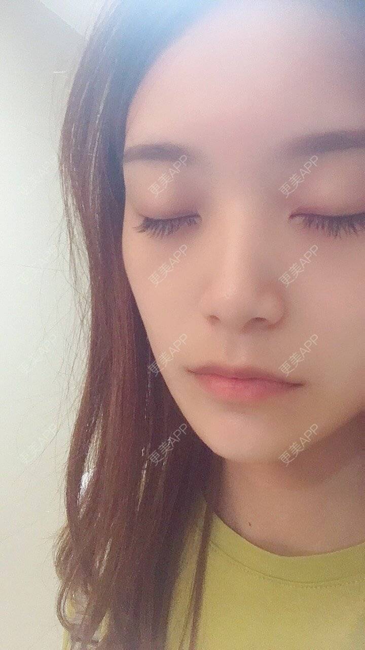 更美 - 更美用户cB5ajb4xmU的美白套餐经验 | 成都 | 美白套餐