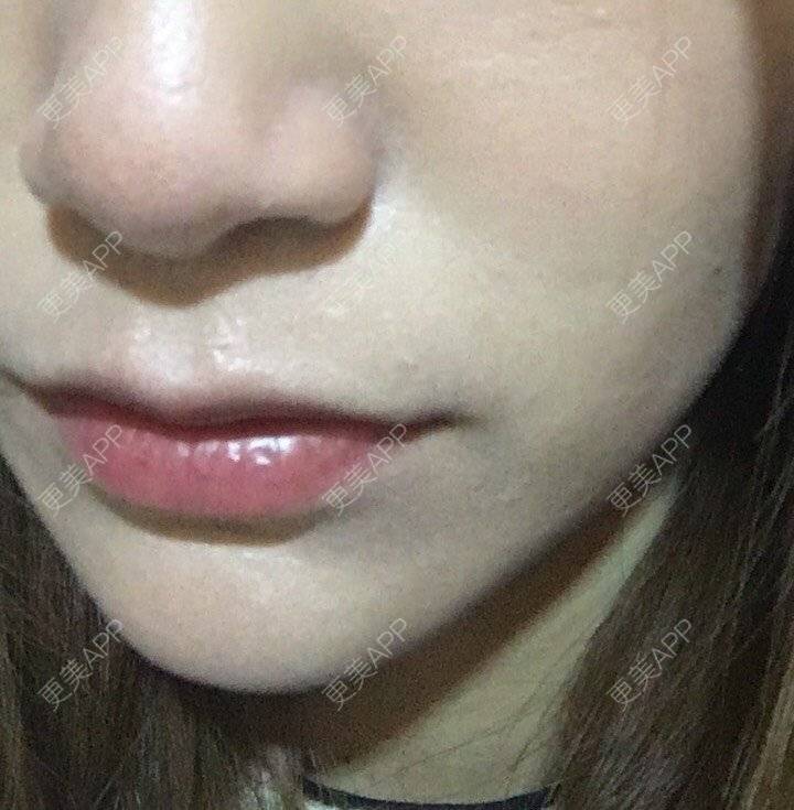 更美 - 更美用户cB5ajb4xmU的美白套餐经验 | 成都 | 美白套餐