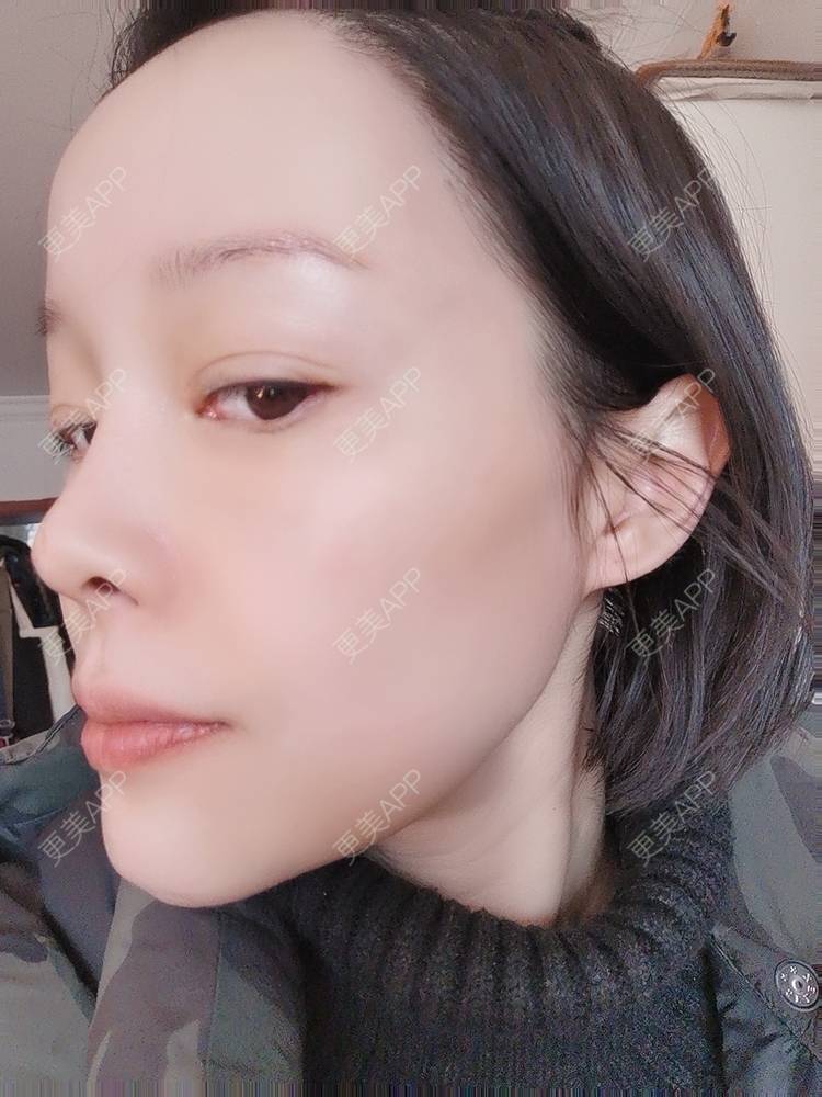 更美 - 🐷🐮仔仔仔的热玛吉经验 | 热玛吉 | 上海
