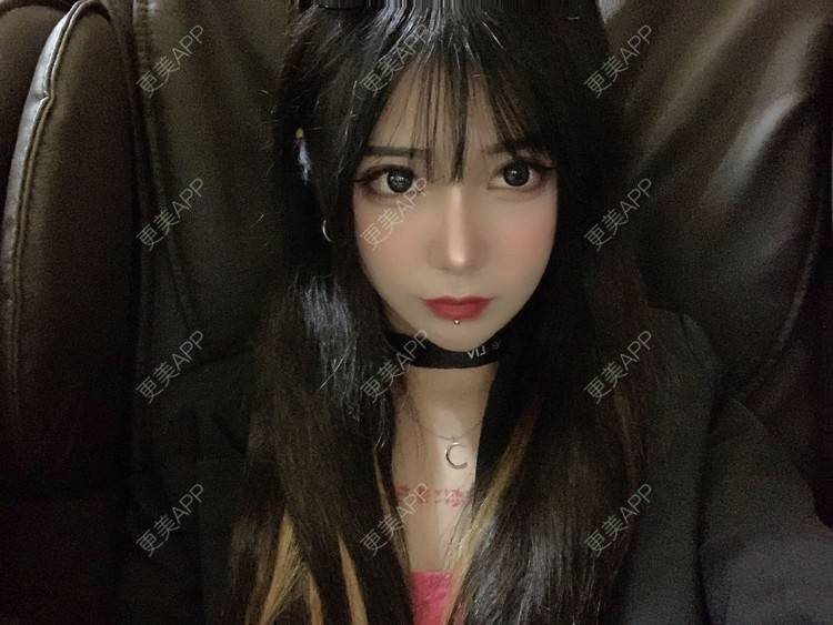 更美 - 尼卡挖土豆的鼻部修复经验 | 鼻中隔软骨隆鼻 | 肋软骨隆鼻 | 鼻形态修复 | 鼻部膨体假体取出 | 鼻部多项 | 鼻部修复 | 玻尿酸鼻基底 | 鼻小柱延长 | 鼻部硅胶假体取出 | 耳软骨隆鼻 | 自体肋软骨垫鼻基底