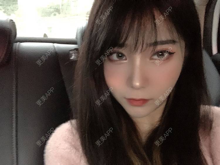 更美 - 尼卡挖土豆的鼻部修复经验 | 鼻中隔软骨隆鼻 | 肋软骨隆鼻 | 鼻形态修复 | 鼻部膨体假体取出 | 鼻部多项 | 鼻部修复 | 玻尿酸鼻基底 | 鼻小柱延长 | 鼻部硅胶假体取出 | 耳软骨隆鼻 | 自体肋软骨垫鼻基底