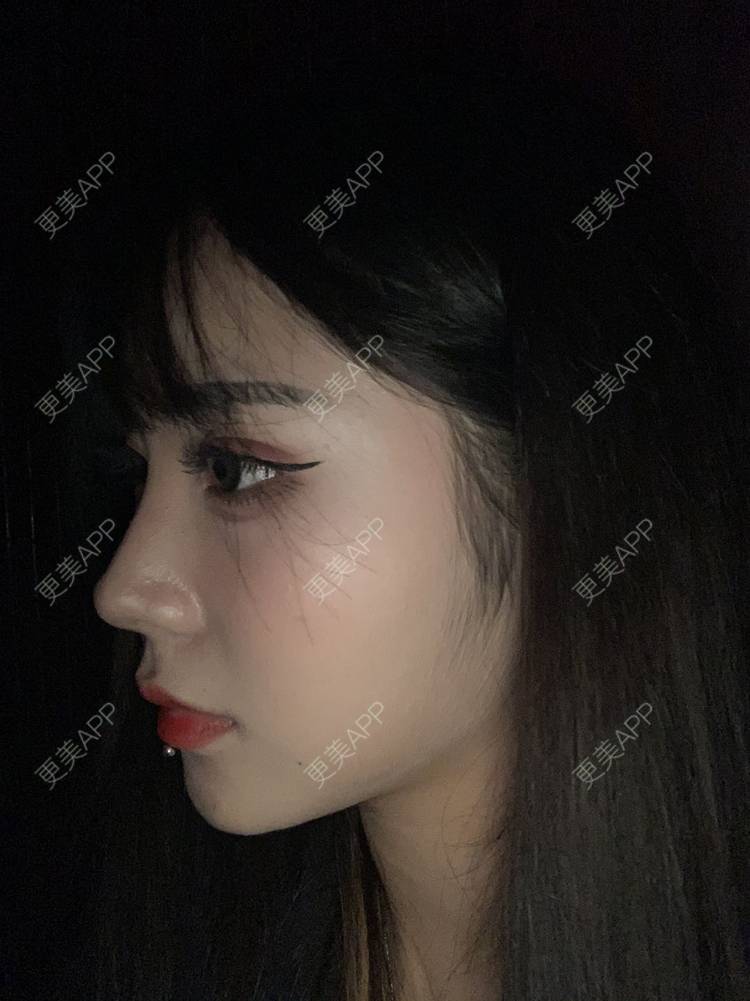 更美 - 尼卡挖土豆的鼻部修复经验 | 鼻中隔软骨隆鼻 | 肋软骨隆鼻 | 鼻形态修复 | 鼻部膨体假体取出 | 鼻部多项 | 鼻部修复 | 玻尿酸鼻基底 | 鼻小柱延长 | 鼻部硅胶假体取出 | 耳软骨隆鼻 | 自体肋软骨垫鼻基底