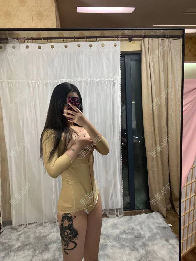 更美 - 尼卡挖土豆的背部吸脂经验 | 吸脂 | 吸脂瘦大腿 | 背部吸脂 | 手臂吸脂 | 腰部吸脂 | 小腿吸脂 | 肩部吸脂 | 腹部吸脂