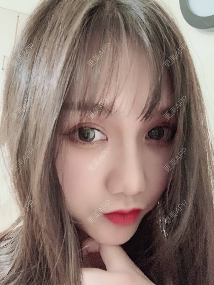 更美 - 杨一诺031的自体脂肪垫下巴经验 | 自体脂肪全面部填充 | 视频日记 | 自体脂肪丰面颊 | 自体脂肪丰太阳穴 | 埋线提升 | 重庆 | 自体脂肪丰额头 | 自体脂肪垫下巴