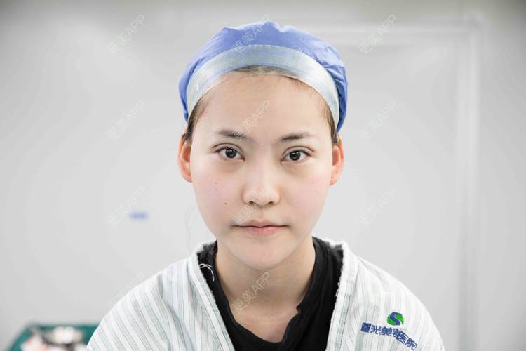 更美 - 小小丽莉的全切双眼皮经验 | 深圳 | 全切双眼皮