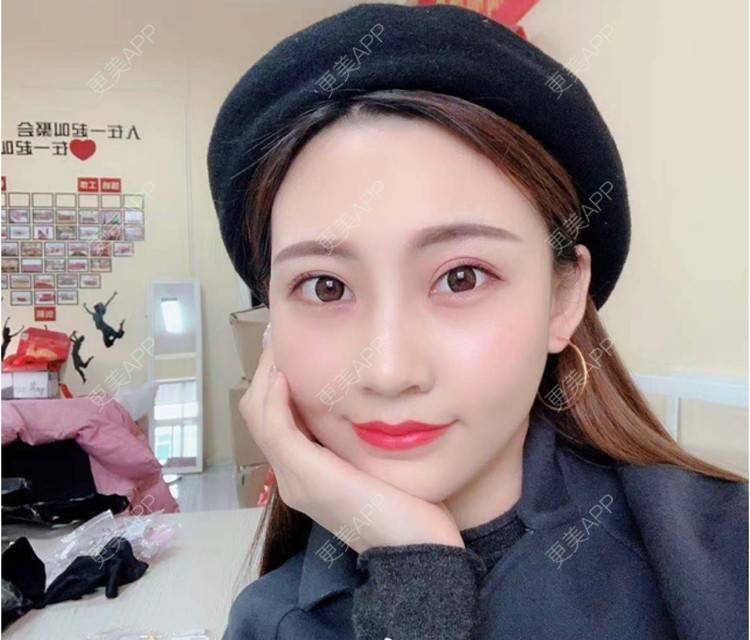 更美 - 更美用户cnu8KVZ0SY的改善鱼尾纹经验 | 上海 | 改善鱼尾纹