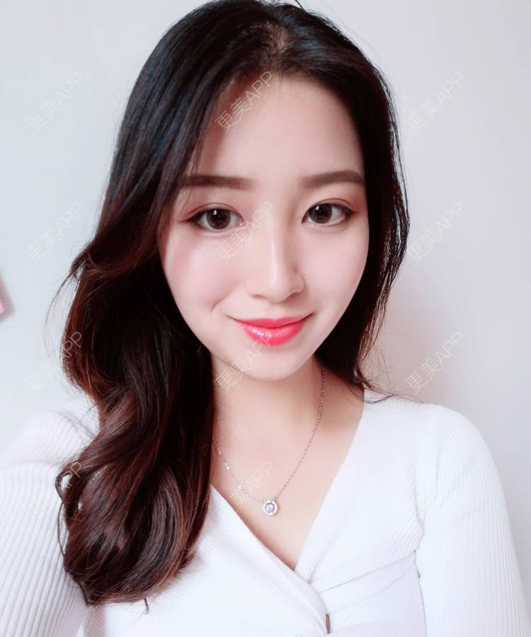 更美用户5f1slcx44y的埋线双眼皮日记