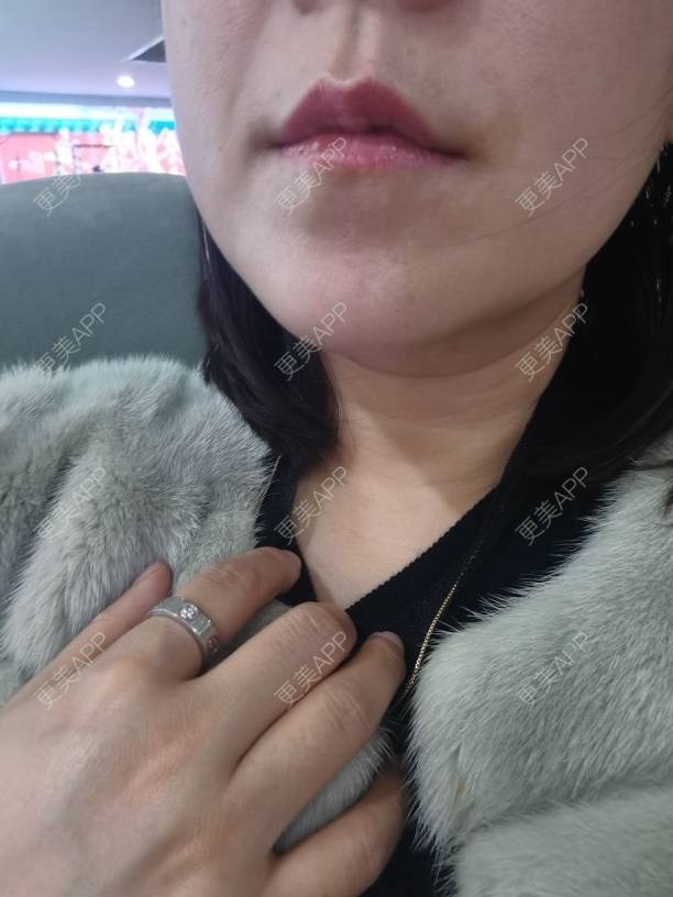 更美 - 更美用户JQiKDssKbO的玻尿酸颈纹经验 | 玻尿酸颈纹 | 重庆