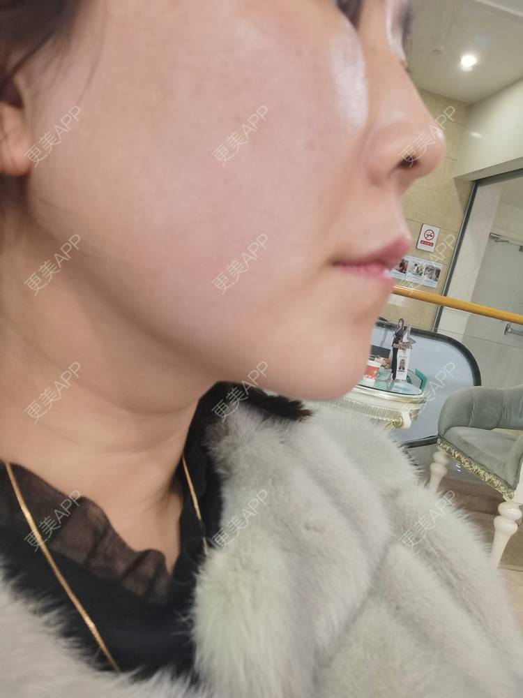 更美 - 更美用户JQiKDssKbO的玻尿酸颈纹经验 | 玻尿酸颈纹 | 重庆