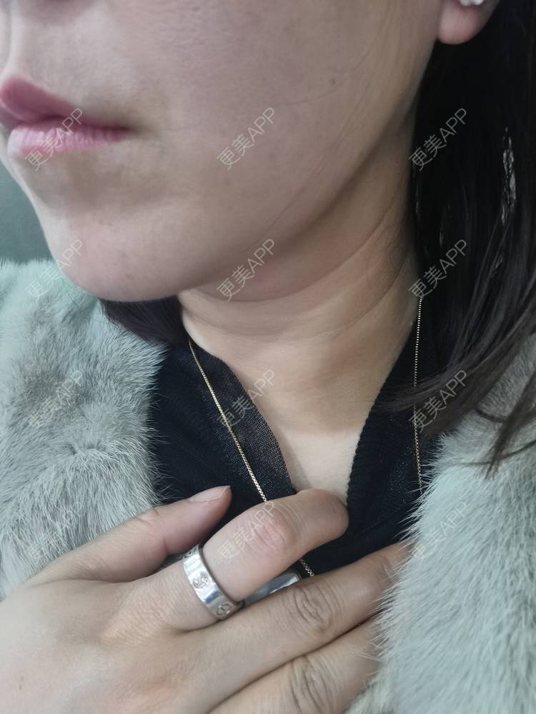更美 - 更美用户JQiKDssKbO的玻尿酸颈纹经验 | 玻尿酸颈纹 | 重庆