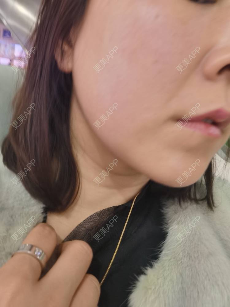 更美 - 更美用户JQiKDssKbO的玻尿酸颈纹经验 | 玻尿酸颈纹 | 重庆