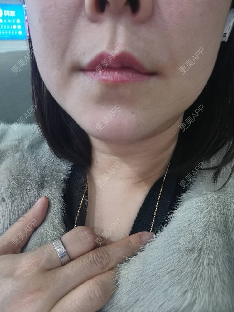 更美 - 更美用户JQiKDssKbO的玻尿酸颈纹经验 | 玻尿酸颈纹 | 重庆