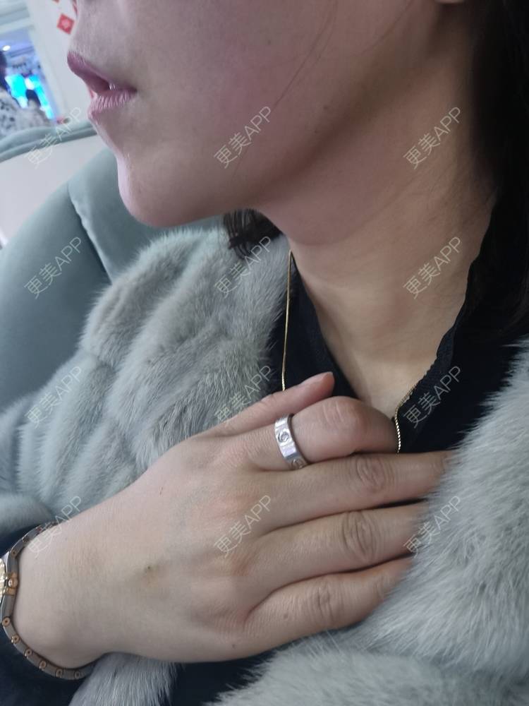 更美 - 更美用户JQiKDssKbO的玻尿酸颈纹经验 | 玻尿酸颈纹 | 重庆