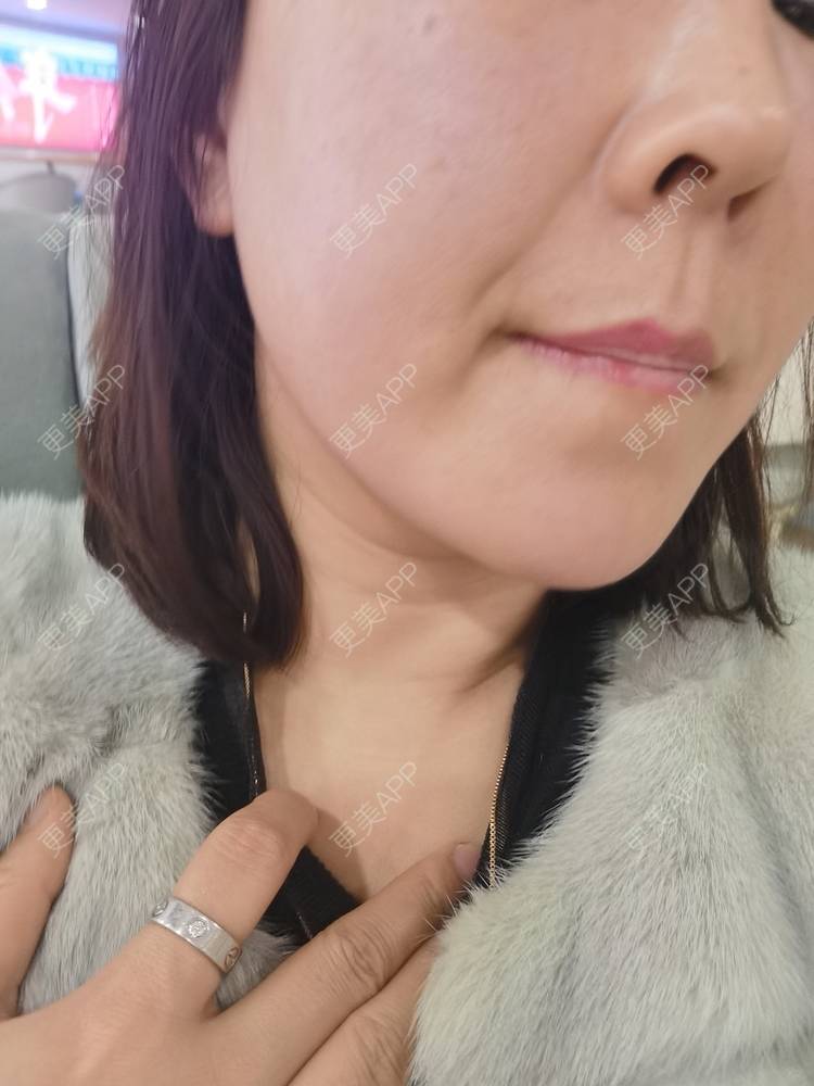 更美 - 更美用户JQiKDssKbO的玻尿酸颈纹经验 | 玻尿酸颈纹 | 重庆