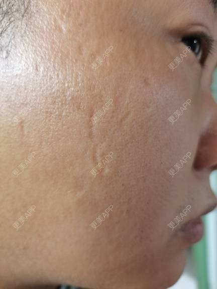 更美 - 俊伊的点阵激光经验 | 杭州 | 点阵激光