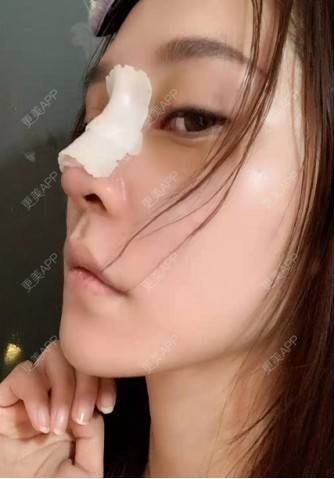 更美 - 孙路的耳软骨隆鼻经验 | 沈阳 | 耳软骨隆鼻