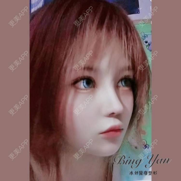 更美 - 祢的美丽/我的职责的肋软骨隆鼻经验 | 肋软骨隆鼻 | 眼部多项 | 上海