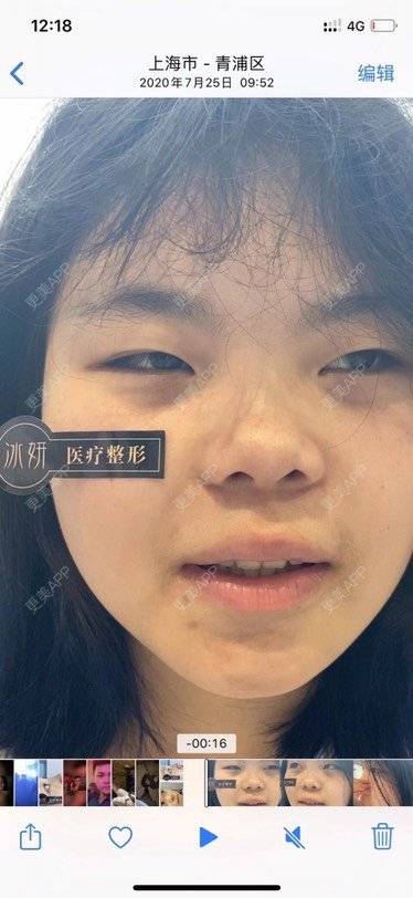 更美 - 祢的美丽/我的职责的肋软骨隆鼻经验 | 肋软骨隆鼻 | 眼部多项 | 上海