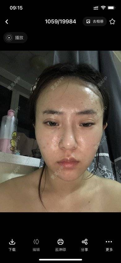 更美 - 樊Bb的微整修复经验 | 玻尿酸下巴 | 玻尿酸额头 | 微整修复 | 玻尿酸太阳穴 | 沈阳 | 玻尿酸
