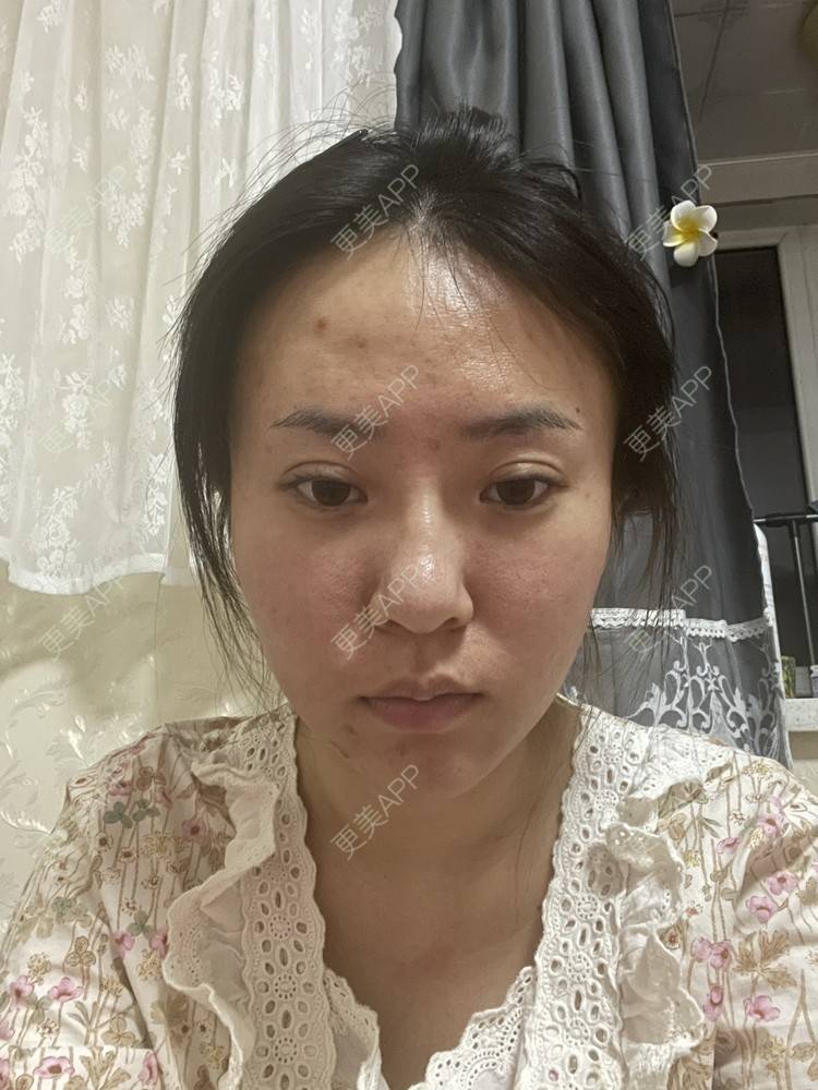 更美 - 樊Bb的微整修复经验 | 玻尿酸下巴 | 玻尿酸额头 | 微整修复 | 玻尿酸太阳穴 | 沈阳 | 玻尿酸
