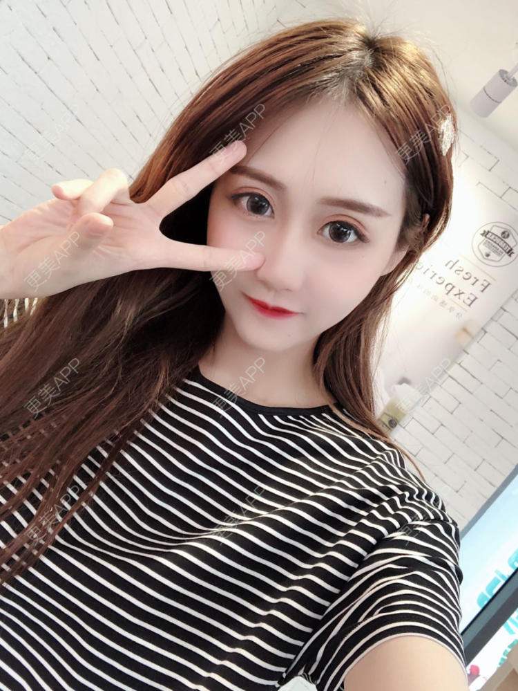 更美 - 巫小思的自体脂肪面部填充经验 | 自体脂肪面部填充 | 视频日记 | 泉州