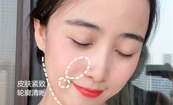 更美 - 更美用户4J9IrOAAYI的热拉提经验 | 热拉提