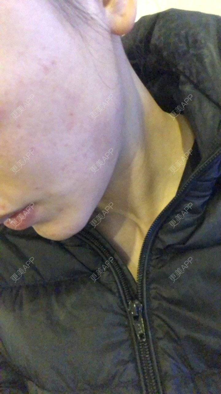 更美 - ancyy的除皱瘦脸经验 | 注射溶脂瘦脸 | 除皱瘦脸 | 南昌