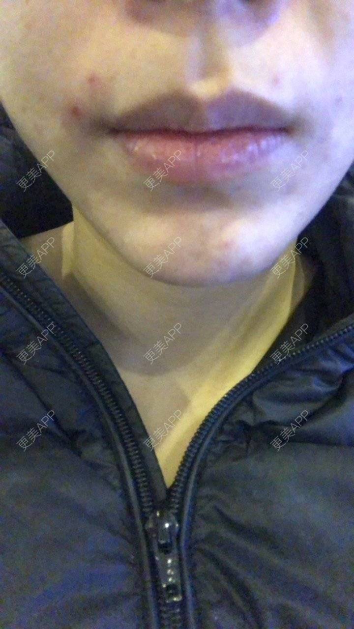 更美 - ancyy的除皱瘦脸经验 | 注射溶脂瘦脸 | 除皱瘦脸 | 南昌