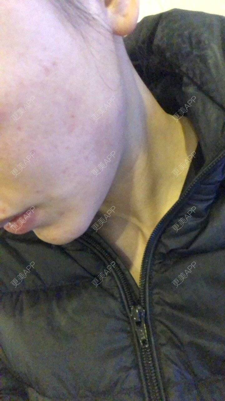 更美 - ancyy的除皱瘦脸经验 | 除皱瘦脸 | 南昌 | 注射溶脂瘦脸