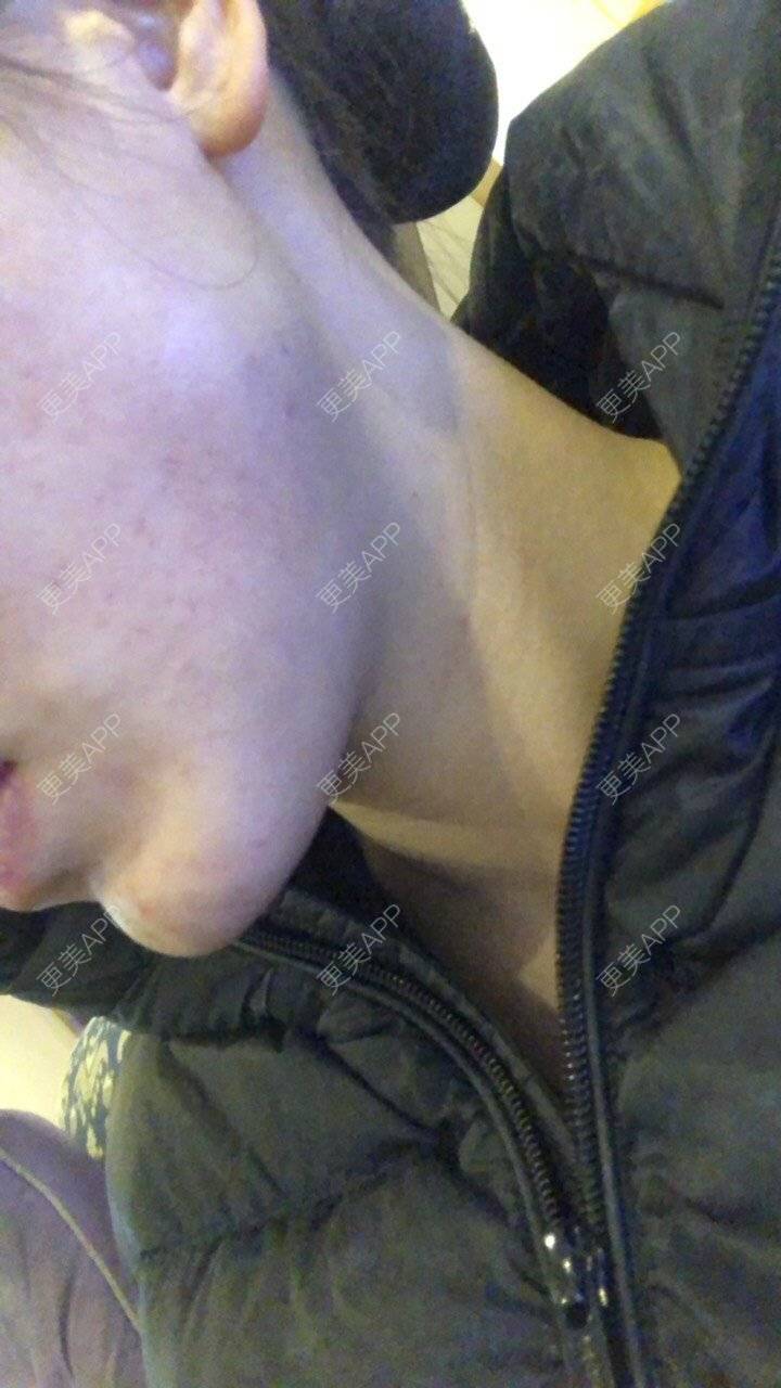 更美 - ancyy的除皱瘦脸经验 | 除皱瘦脸 | 南昌 | 注射溶脂瘦脸