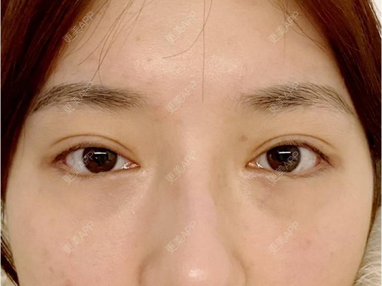 更美 - 爱生活爱尼美的双眼皮经验 | 双眼皮 | 西安