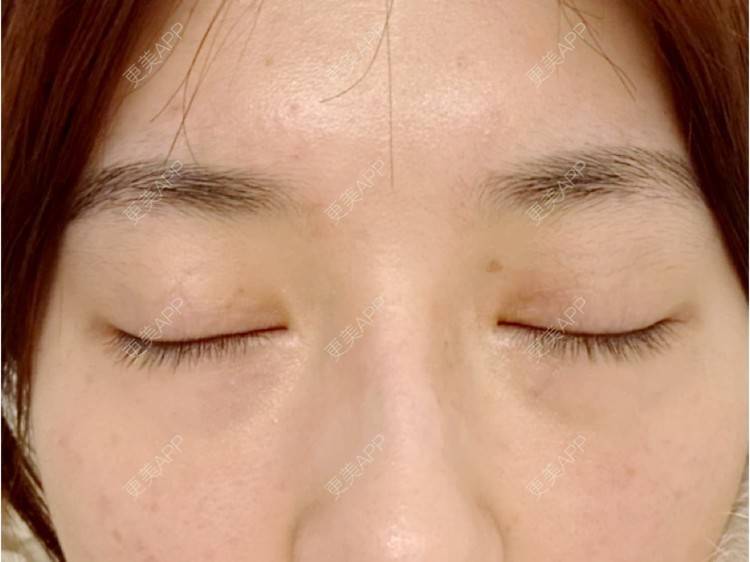 更美 - 爱生活爱尼美的双眼皮经验 | 双眼皮 | 西安