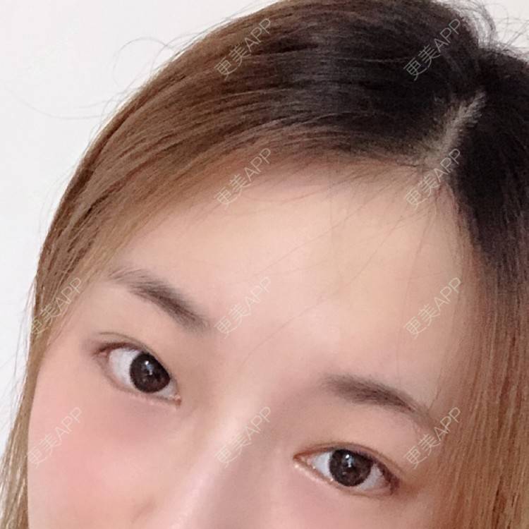 更美 - 爱生活爱尼美的双眼皮经验 | 双眼皮 | 西安