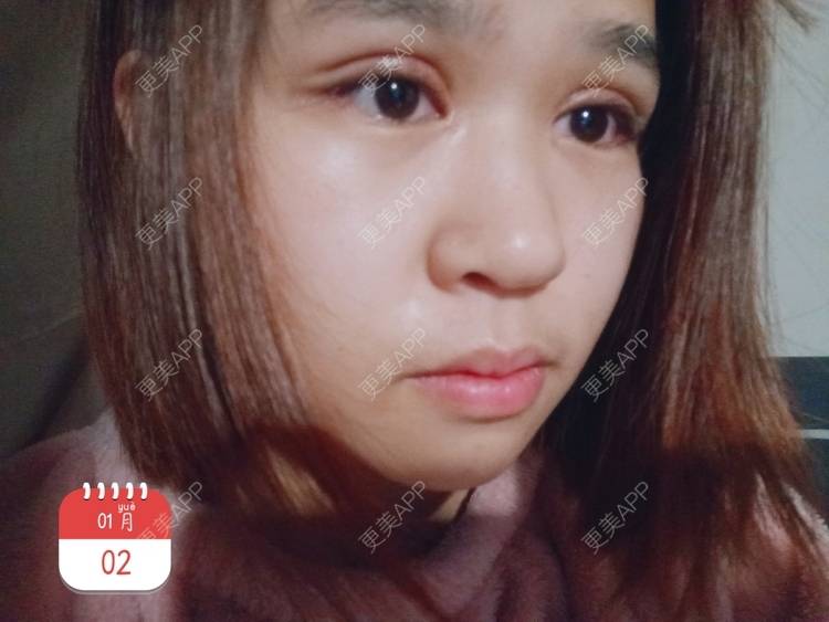 更美 - auci的眼部多项经验 | 昆明 | 眼部多项