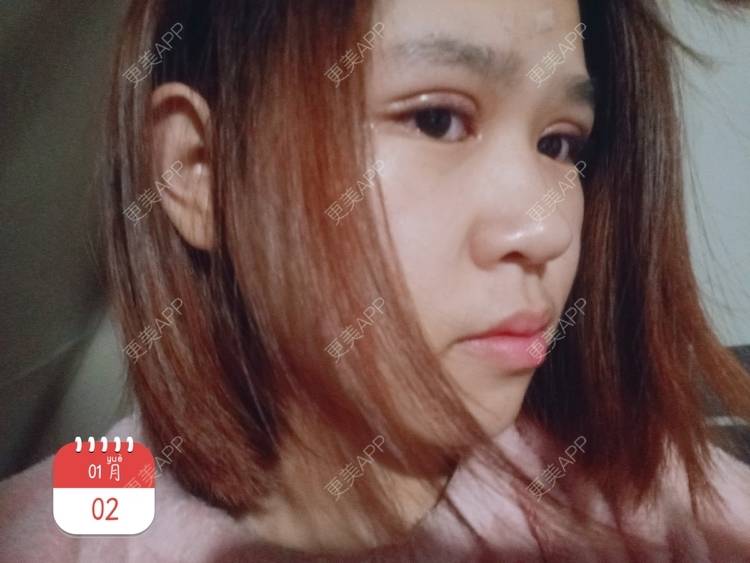 更美 - auci的眼部多项经验 | 昆明 | 眼部多项