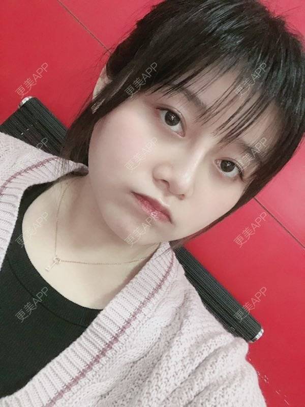 更美 - 小泥泥的吸脂瘦脸经验 | 吸脂瘦脸 | 双下巴吸脂 | 深圳